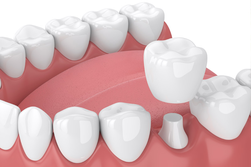 Dental Crowns in St. Louis